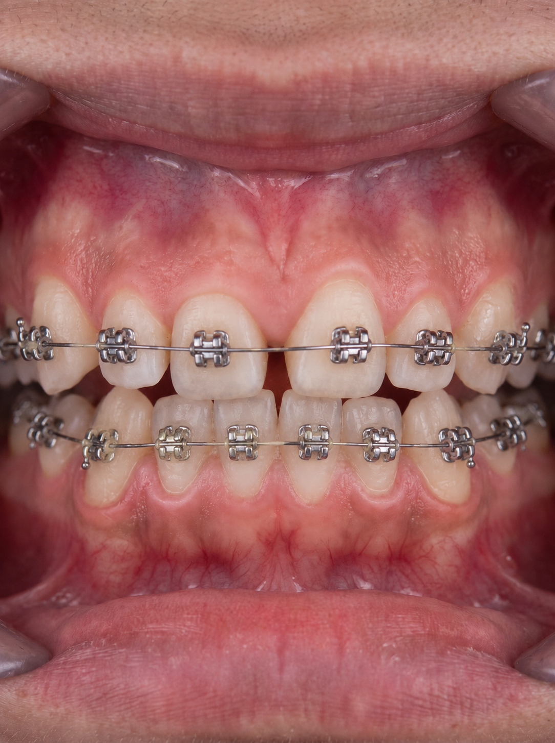 Orthodontics - Before treatment